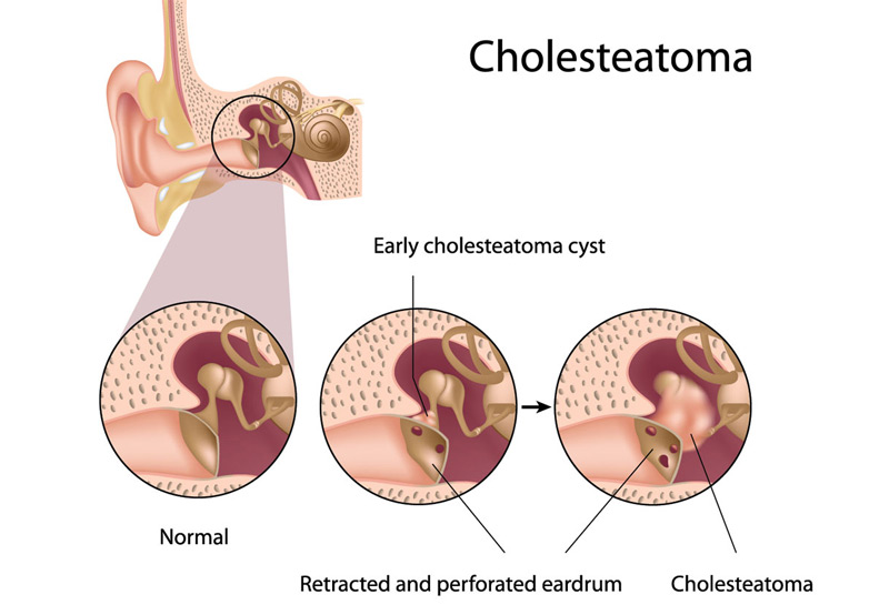 Cholesteatoma-Dr.-Hamid-Djalilian