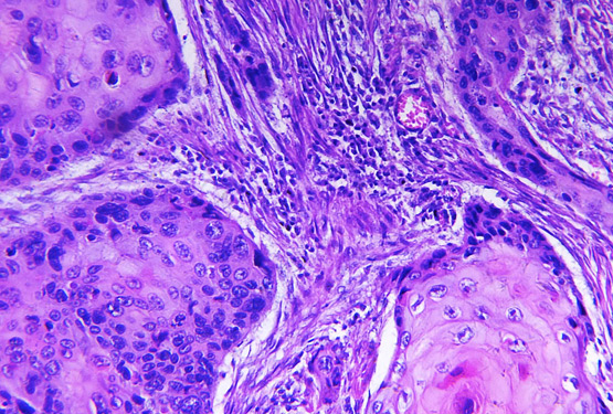 Squamous-Cell-Carcinoma-of-Ear-and-Temporal-Bone